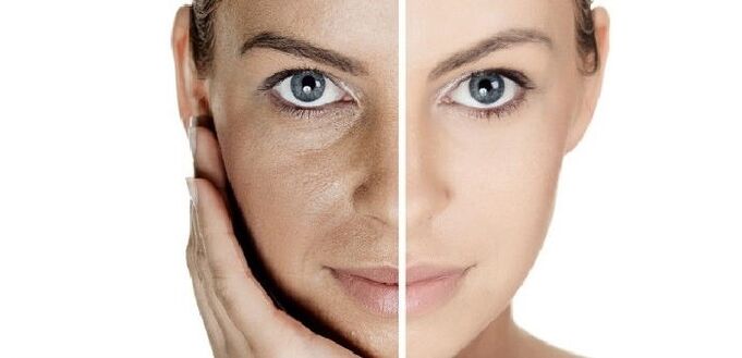 преди и след подмладяване на кожата на лицето