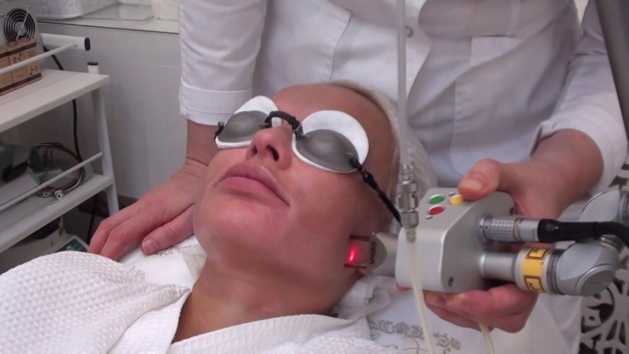 Лечение с лазерен лъч на проблемни участъци от кожата на лицето