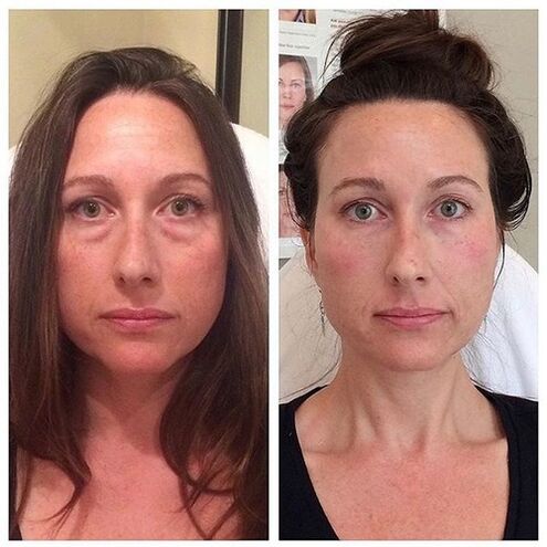 Момиче преди и след лазерно подмладяване на лицето