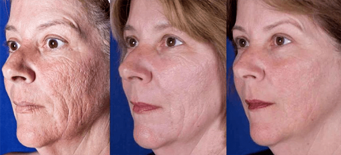 Резултат след лазерна процедура за подмладяване на кожата на лицето