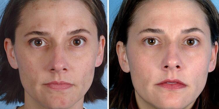 преди и след подмладяване на кожата с устройството
