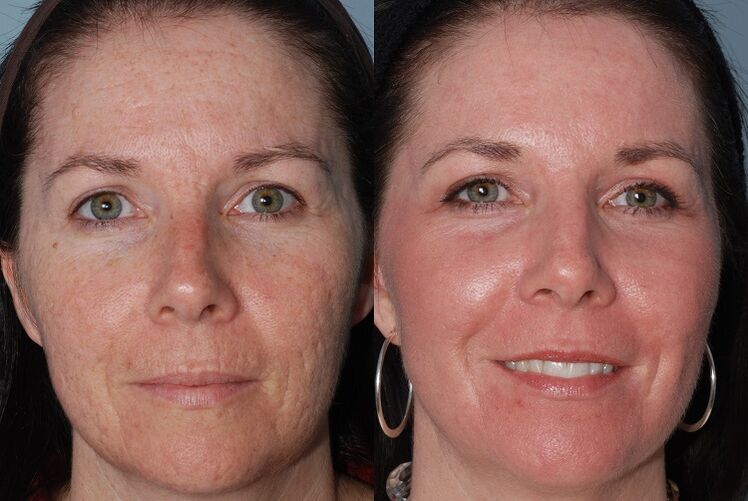 преди и след хардуерно подмладяване на кожата
