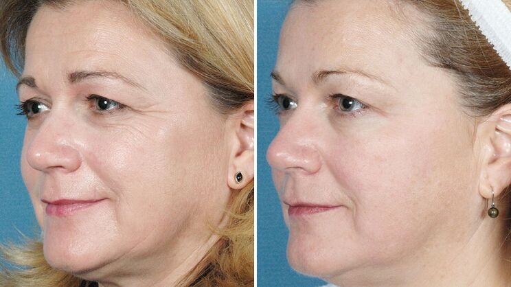 снимки преди и след хардуерно подмладяване на кожата