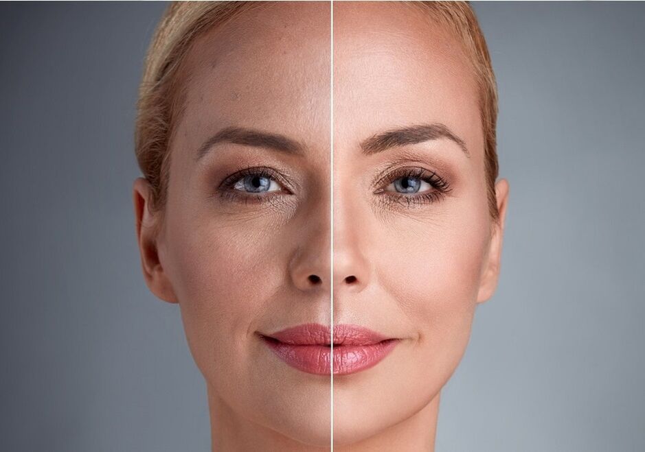 преди и след лазерно подмладяване на лицето