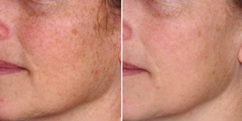 кожа на лицето преди и след подмладяване