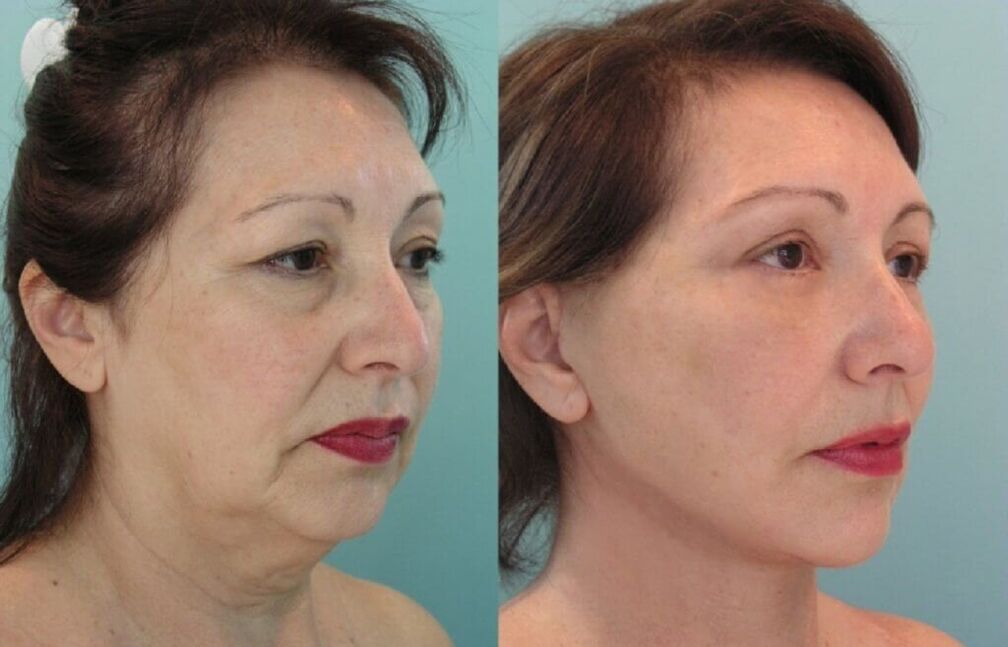 снимка преди и след подмладяване на кожата